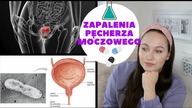 ZAPALENIE PECHERZA MOCZOWEGO| Nawracajace co kilka miesiecy