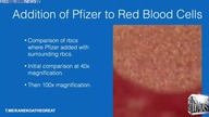 Dr.  Richard Fleming: Zastrzyk mRNA powoduje powstawanie zakrzep&oacute;w krwi pod mikroskopem- LEKT