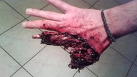 Niebezpieczne skutki "zabawy" petardami +18
