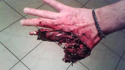 Niebezpieczne skutki "zabawy" petardami +18