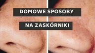 Oto domowa recepta na zaskórniki! - Pozbądź się wągrów stosując domowe metody